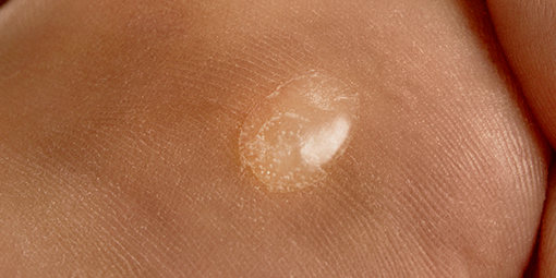 Gros plan d’un talon représentant une surface de peau remplie de fluide ou une ampoule Gros plan d’un talon représentant une surface de peau remplie de fluide ou une ampoule